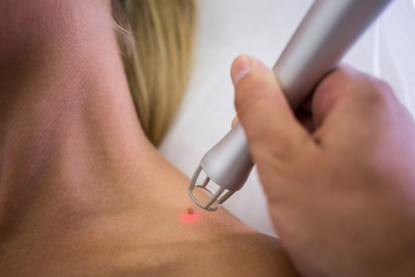 Biostimulierenden Laser
